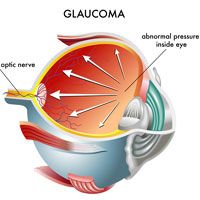 3-D illustration of the inside of an eyeball suffering from glaucoma